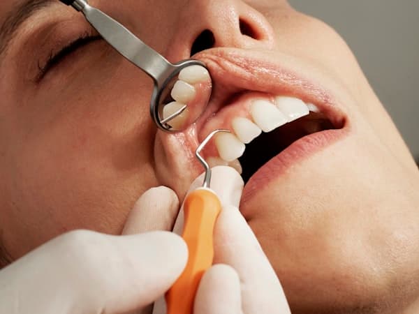 Teeth whitening